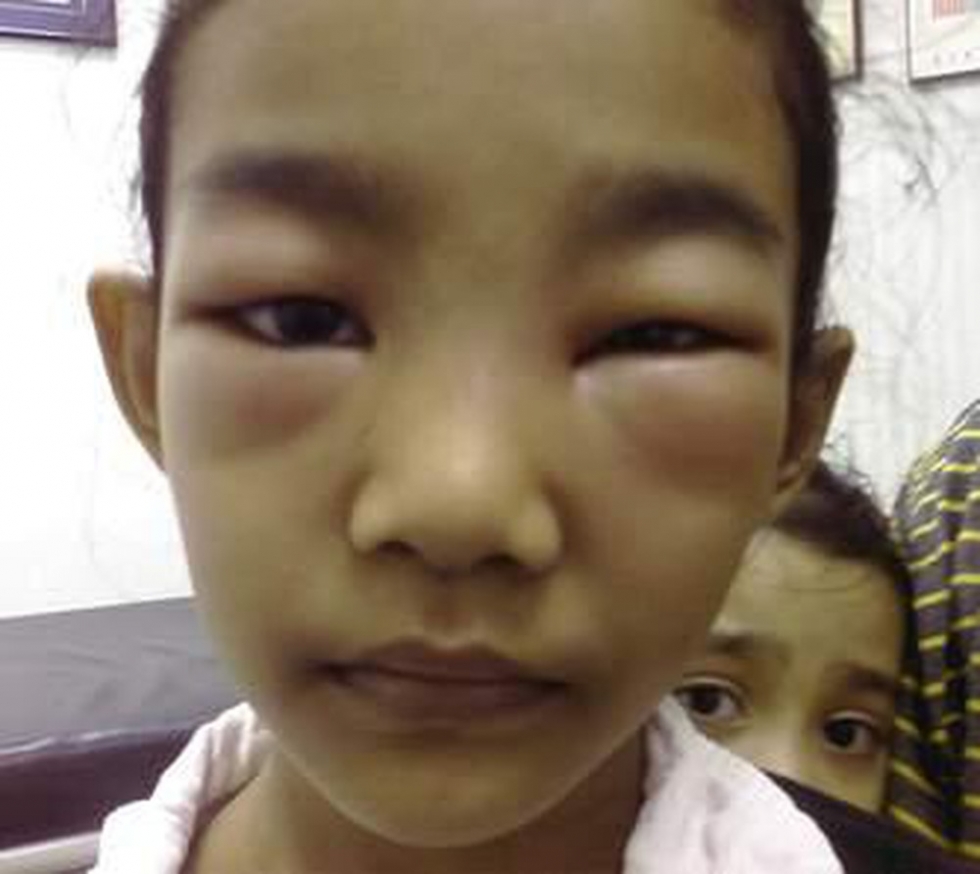 Phù nề ở trẻ bị hội chứng thận hư